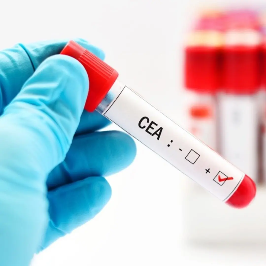 Antígeno Carcinoembrionario (CEA): Qué es, qué detecta y cuándo es elevado - Qué enfermedades detecta el antígeno carcinoembrionario antigeno carcinoembrionario cea - Qué enfermedades detecta el antígeno carcinoembrionario