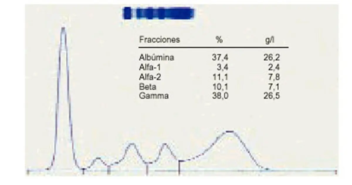 Proteinograma: Qué es, para qué sirve y cómo se interpreta - Qué enfermedades detecta la electroforesis de proteínas proteinograma para que sirve - Qué enfermedades detecta la electroforesis de proteínas
