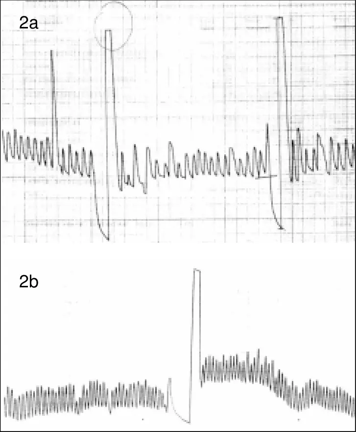 Espirometría: Qué enfermedades detecta y cómo se realiza - Qué enfermedades detecta la espirometría espirograma - Qué enfermedades detecta la espirometría