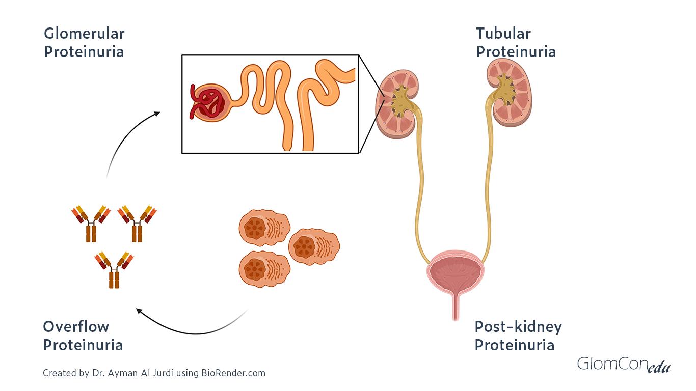 Proteinuria: Causas, Diagnóstico y Tratamiento - Qué enfermedades provoca la proteinuria proteinuria - Qué enfermedades provoca la proteinuria