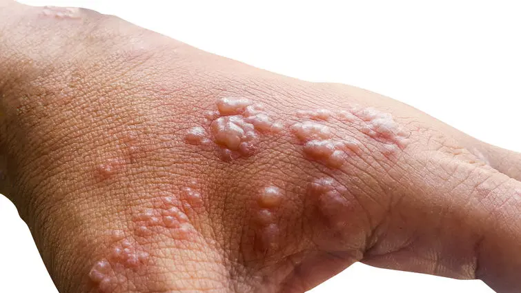 monkeypox - Qué enfermedades transmite el mono al ser humano