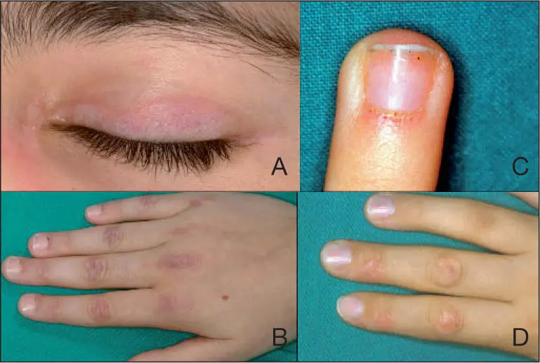 que es la dermatomiositis - Qué es bueno para la dermatomiositis