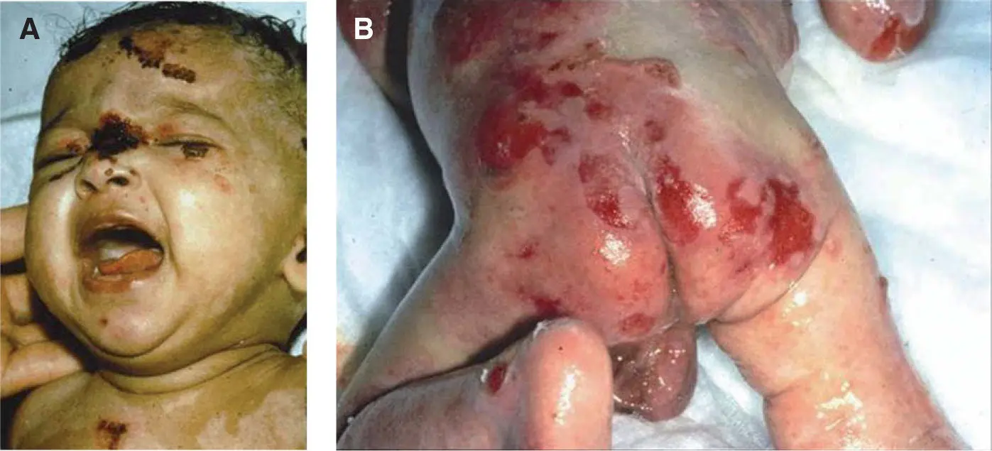 Epidermólisis bullosa: Una mirada profunda a esta rara condición de la piel - Qué es bueno para la epidermolisis epidermolisis - Qué es bueno para la epidermolisis