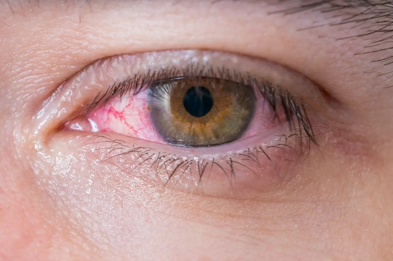 Ojos Rojos en Niños: Conjuntivitis, Causas, Tratamiento y Prevención - Qué es bueno para los ojos rojos en ninos ojos rojos en niños - Qué es bueno para los ojos rojos en ninos