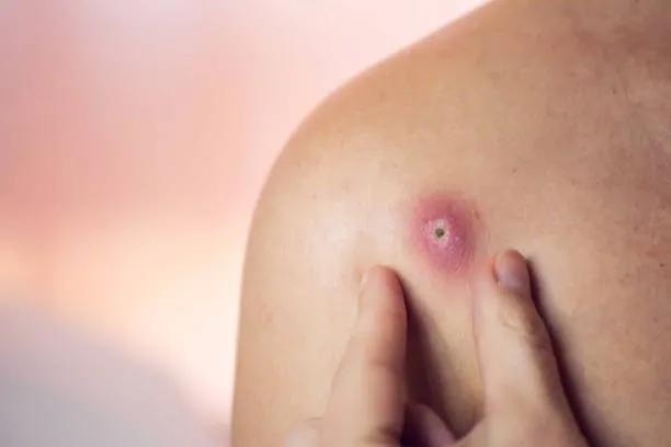 Divieso: Causas, Síntomas y Tratamiento de Esta Infección Cutánea - Qué es divieso en la Biblia divieso - Qué es divieso en la Biblia
