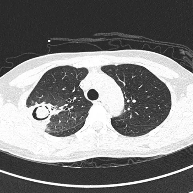 aspergiloma - Qué es el aspergiloma del pulmón