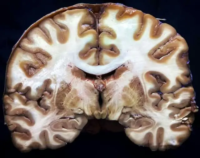 Corte de Charcot: Síntomas, Causas y Tratamiento - Qué es el corte de Charcot corte de charcot - Qué es el corte de Charcot