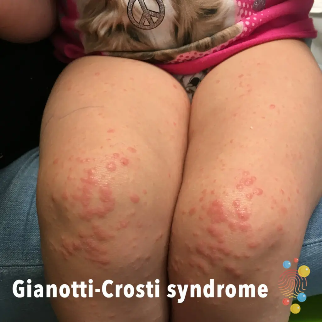 Acrodermatitis de Gianotti-Crosti: Una guía completa - Qué es el crosti crosti - Qué es el crosti