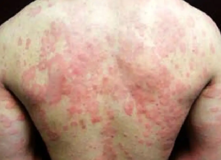 Urticaria Colinérgica: Causas, Síntomas y Tratamiento - Qué es el dermografismo y cómo se cura urticaria facticia - Qué es el dermografismo y cómo se cura