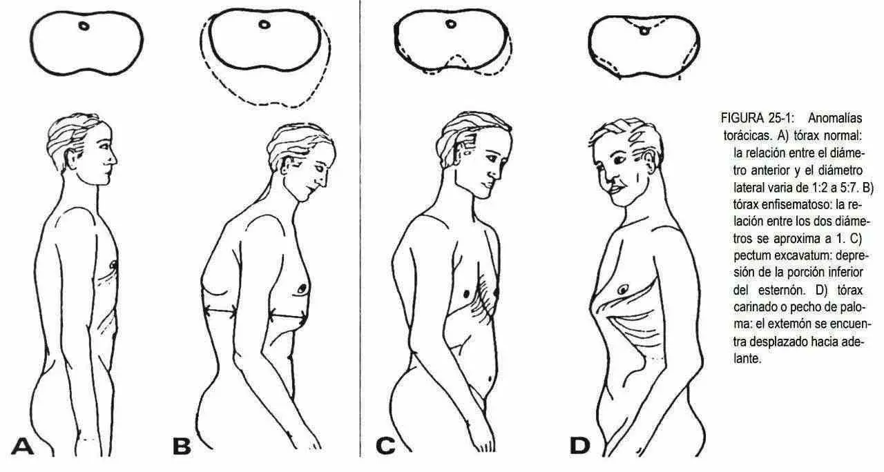 torax efisematoso - Qué es el enfisema pulmonar y cómo se cura