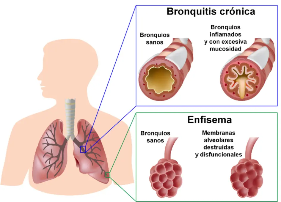 Enfisema Pulmonar: Causas, Síntomas, Prevención y Tratamiento - Qué es el enfisema y qué causa que es enfisema - Qué es el enfisema y qué causa