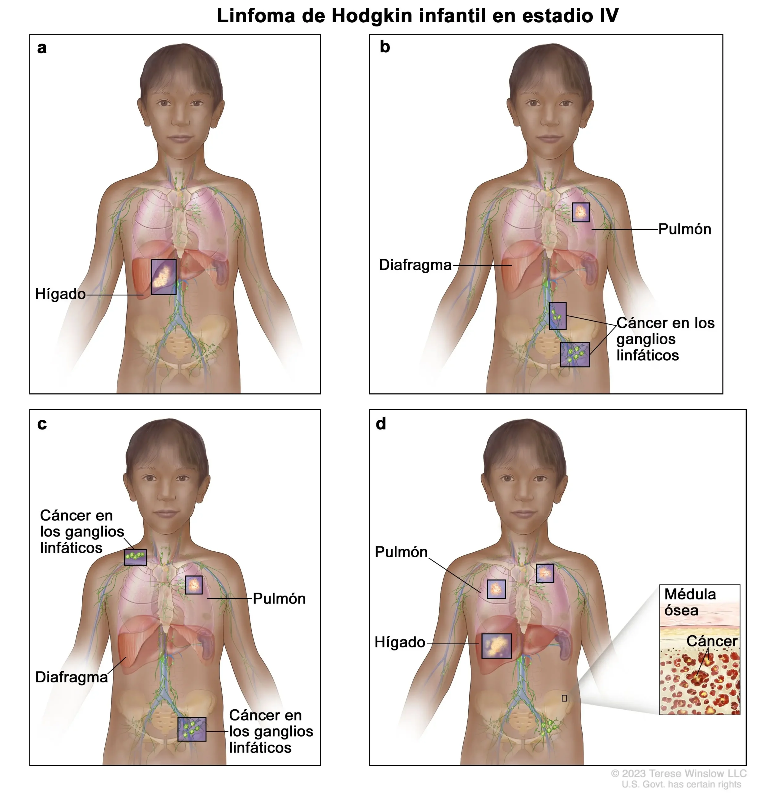 Linfoma de Hodgkin en Niños: Diagnóstico, Síntomas y Tratamiento - Qué es el linfoma de Hodgkin en niños linfoma de hodgkin en niños - Qué es el linfoma de Hodgkin en niños