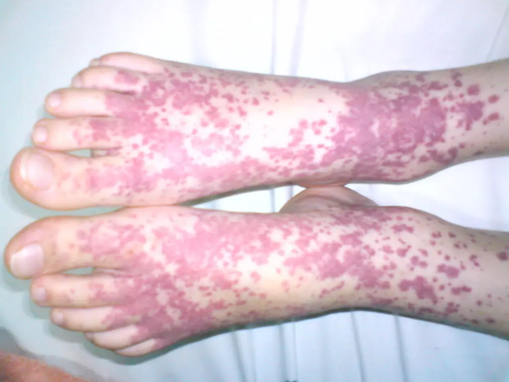 purpura de schonlein henoch sap - Qué es el psh en la sangre