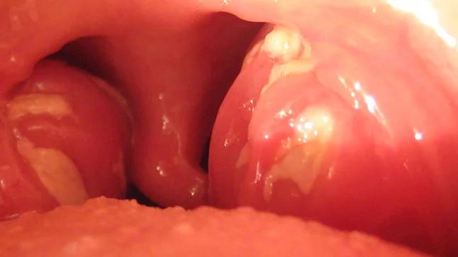 Síndrome Mononucleósico: Todo lo que Debes Saber - Qué es el síndrome mononucleosico sindrome mononucleosico - Qué es el síndrome mononucleosico