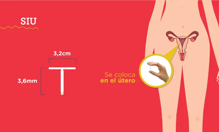 SIU Minera: El dispositivo intrauterino para la planificación familiar - Qué es el sistema SIU siu minera - Qué es el sistema SIU