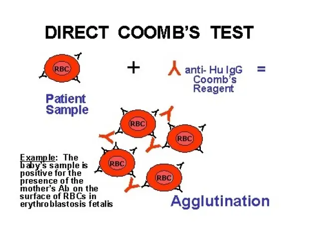 Test de Coombs: Qué es, para qué sirve y cómo interpretar los resultados - Qué es el test de Coombs y para qué sirve test de coombs - Qué es el test de Coombs y para qué sirve