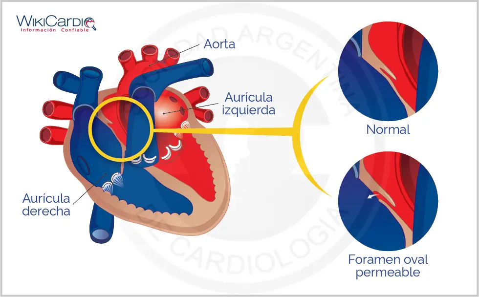 Fibrodisplasia Osificante Progresiva (FOP): Una Enfermedad Rara y Devastadora - Qué es FOP fop cardiologia - Qué es FOP