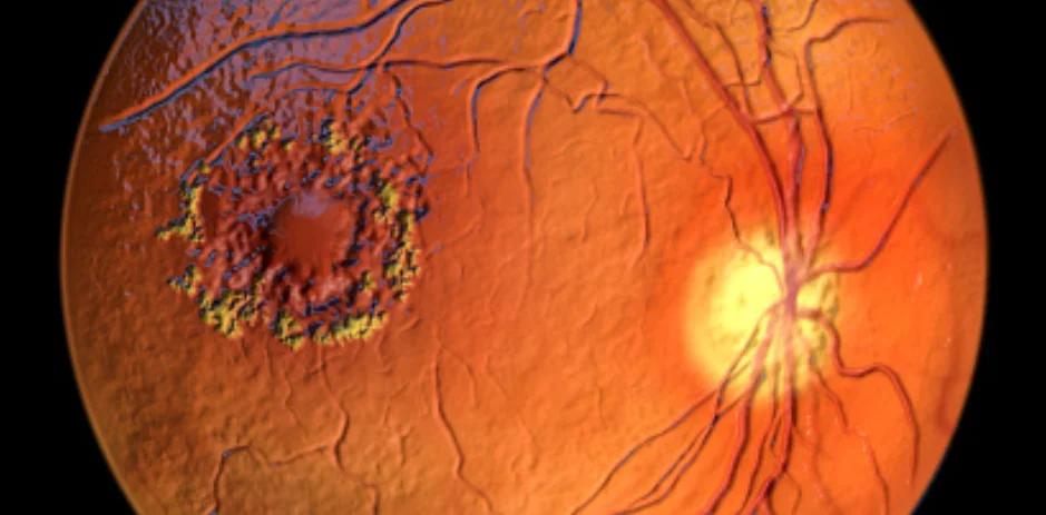 Amaurosis Congénita de Leber: Causas, Síntomas y Diagnóstico - Qué es la amaurosis de leber y por qué se debe que ocurra este padecimiento amaurosis congenita de leber - Qué es la amaurosis de leber y por qué se debe que ocurra este padecimiento