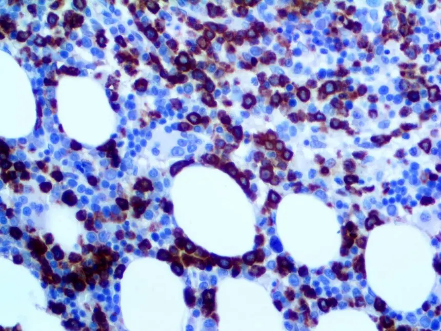 Mieloperoxidasa: Un Marcador Clave en la Detección de Enfermedades - Qué es la anti mieloperoxidasa mieloperoxidasa - Qué es la anti mieloperoxidasa