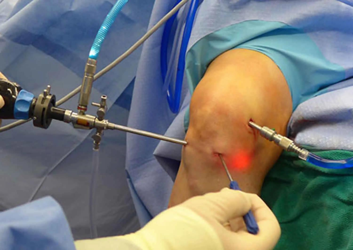 Artroscopia simple de rodilla: Todo lo que necesitas saber - Qué es la artroscopia simple artroscopia simple de rodilla - Qué es la artroscopia simple