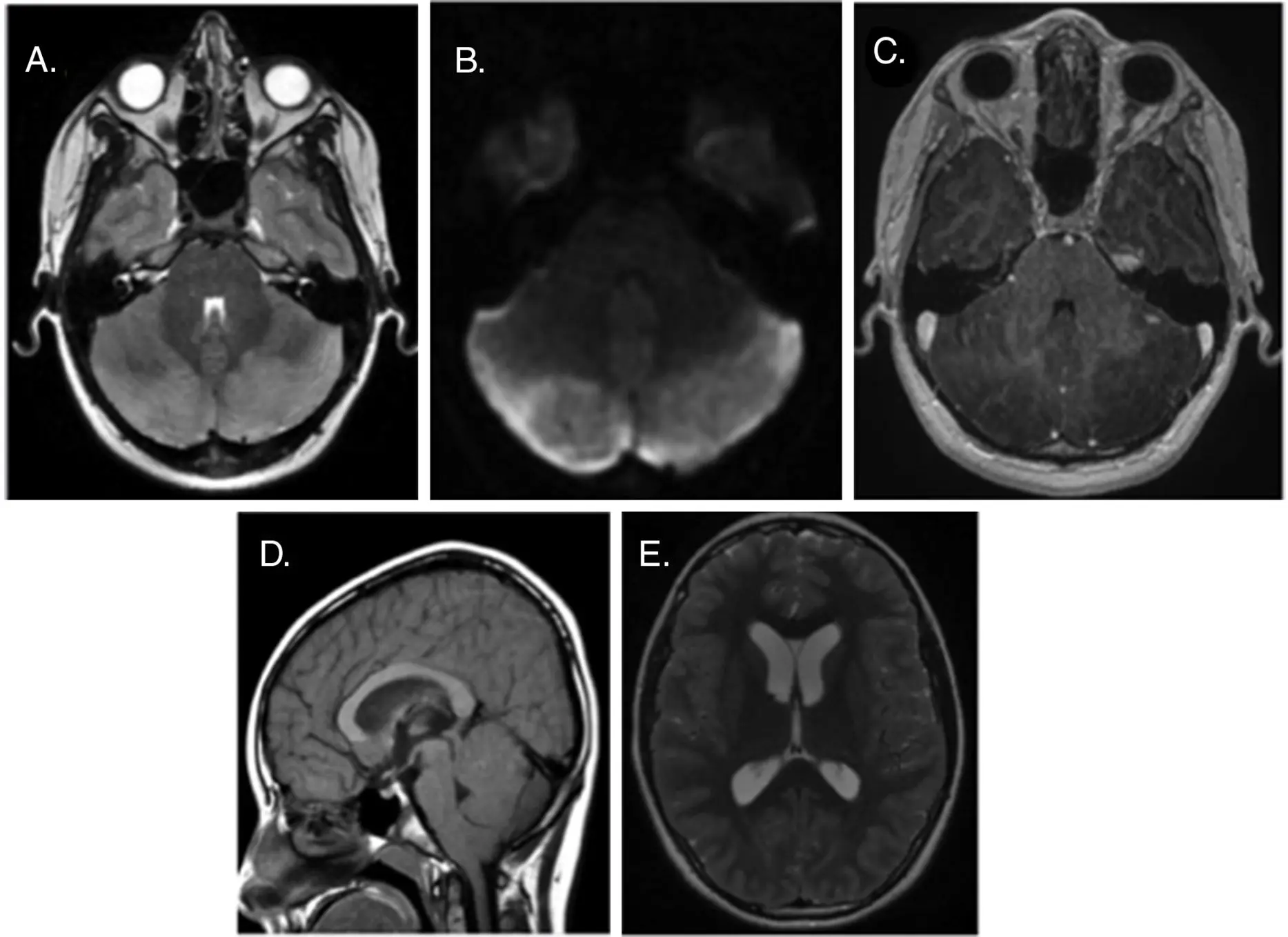 Cerebelitis en niños: causas, síntomas y tratamiento - Qué es la ataxia cerebelosa en niños cerebelitis - Qué es la ataxia cerebelosa en niños