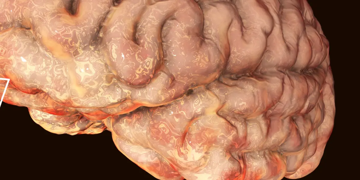 Cisticercosis: Una Infección Parasitaria que Afecta al Cerebro - Qué es la cisticercosis y qué la provoca cisticercosis - Qué es la cisticercosis y qué la provoca