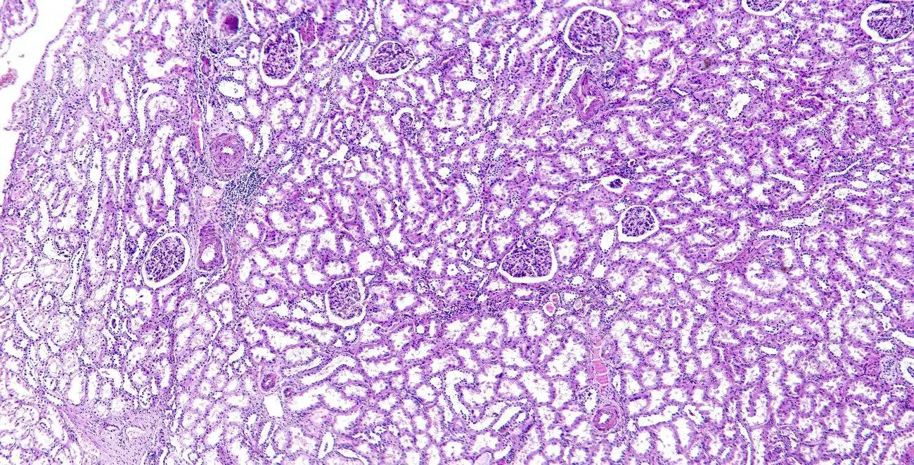 Degeneración Hialina: Un Fenómeno Común en los Leiomiomas Uterinos - Qué es la degeneración hialina degeneracion hialina - Qué es la degeneración hialina