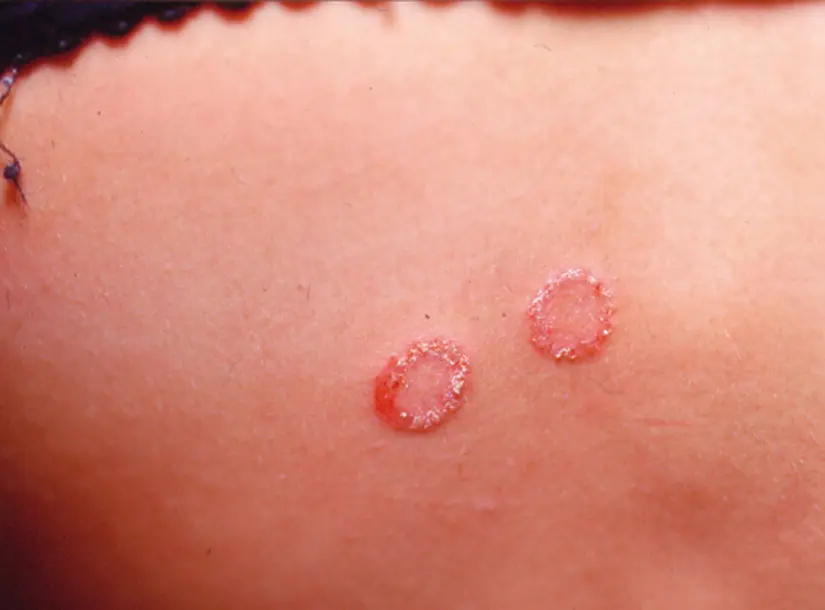Dermatomicosis: Causas, Síntomas y Tratamiento - Qué es la dermatomicosis dermatomicosis - Qué es la dermatomicosis