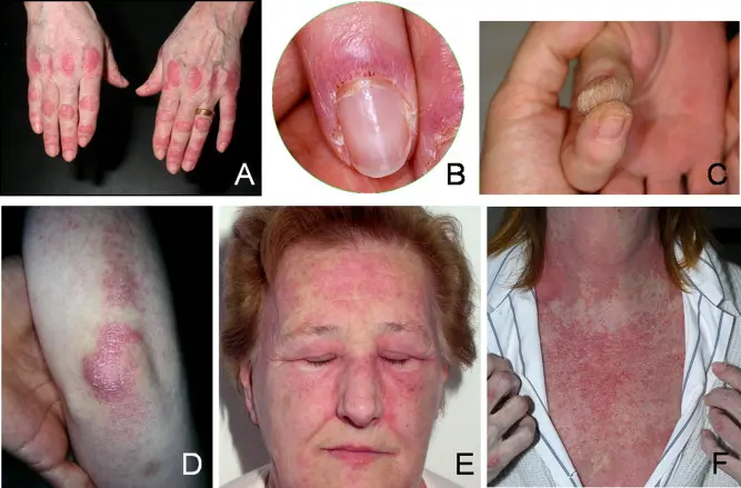 Dermatopolimiositis: Una enfermedad autoinmune que afecta a niños y adultos - Qué es la dermatopolimiositis dermatopolimiositis - Qué es la dermatopolimiositis