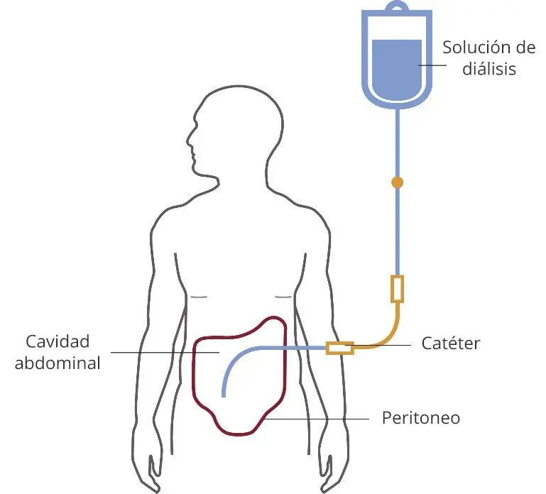 La diálisis: Una guía completa para entender y gestionar este tratamiento renal - Qué es la diálisis y cómo se realiza dialisis - Qué es la diálisis y cómo se realiza