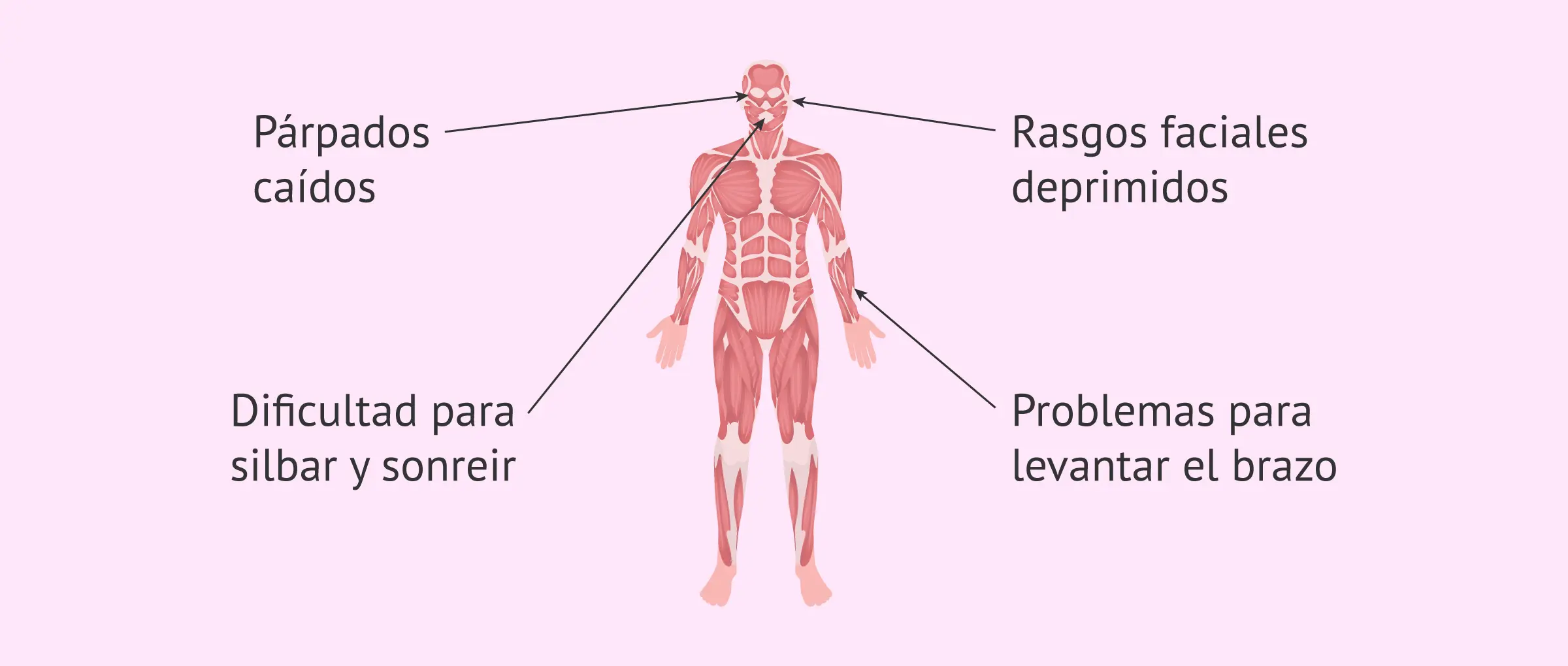 Distrofia Facioescapulohumeral (FSHD): Una mirada a la debilidad muscular progresiva - Qué es la distrofia facial distrofia facio escapulo humeral - Qué es la distrofia facial