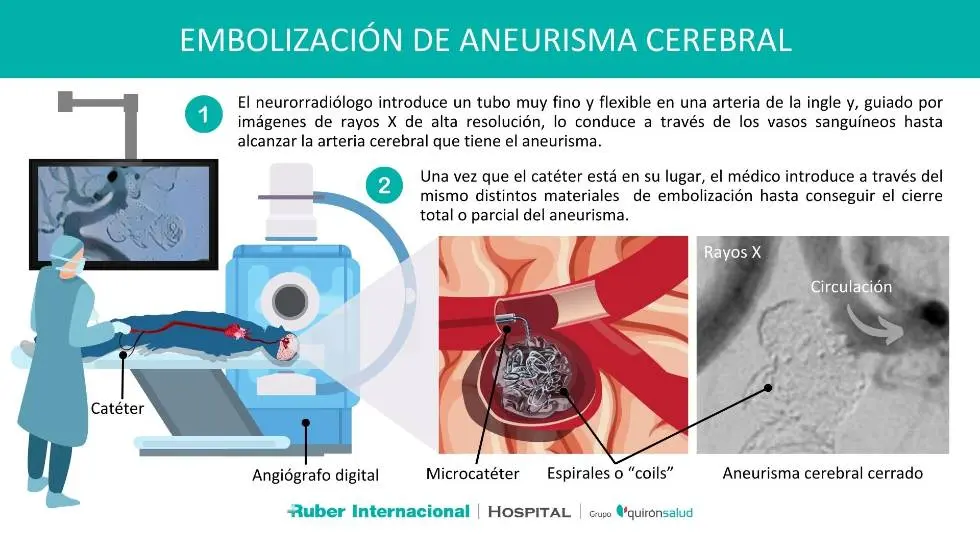 Embolización de Aneurisma Cerebral: Un Procedimiento para Tratar Aneurismas - Qué es la embolización de aneurisma cerebral embolizacion aneurisma cerebral - Qué es la embolización de aneurisma cerebral