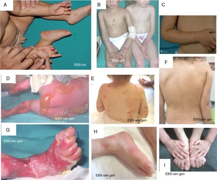 Epidermólisis bullosa: Una mirada profunda a esta rara condición de la piel - Qué es la epidermolisis epidermolisis - Qué es la epidermolisis