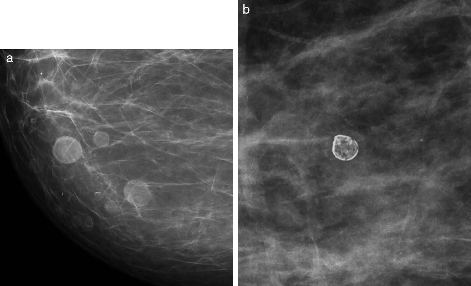 Esclerosis Estromal en Mama: Una Lesión Benigna que Puede Simular Cáncer - Qué es la esclerosis estromal de mama esclerosis estromal en mama - Qué es la esclerosis estromal de mama