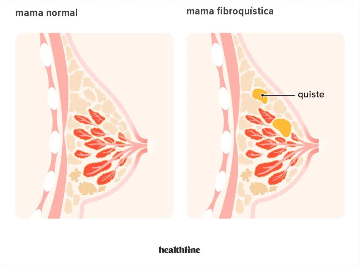 Esclerosis Estromal en Mama: Una Lesión Benigna que Puede Simular Cáncer - Qué es la esclerosis estromal densa esclerosis estromal en mama - Qué es la esclerosis estromal densa