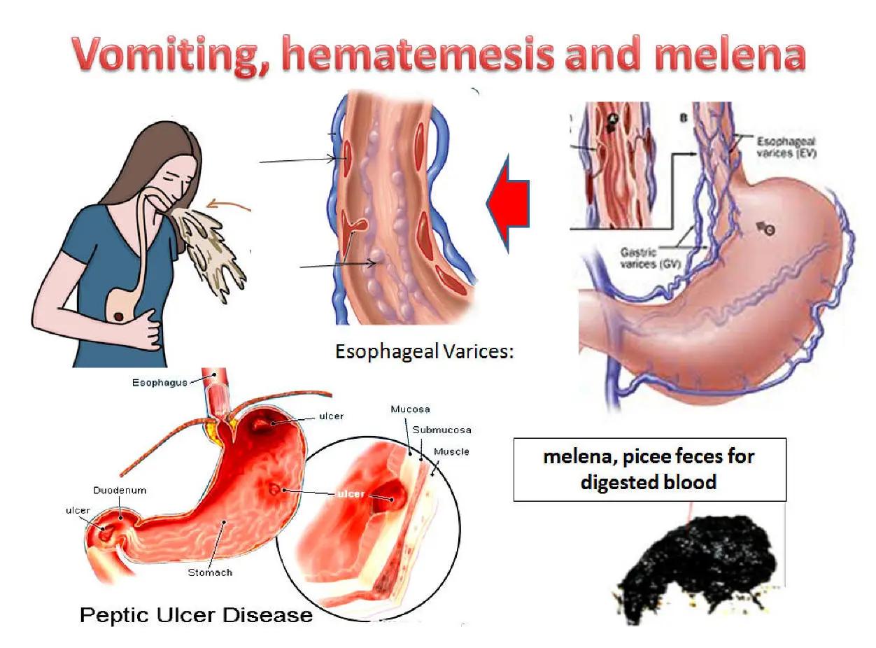 Hematemesis: Causas, Síntomas y Tratamiento - Qué es la hematemesis hematemesis - Qué es la hematemesis