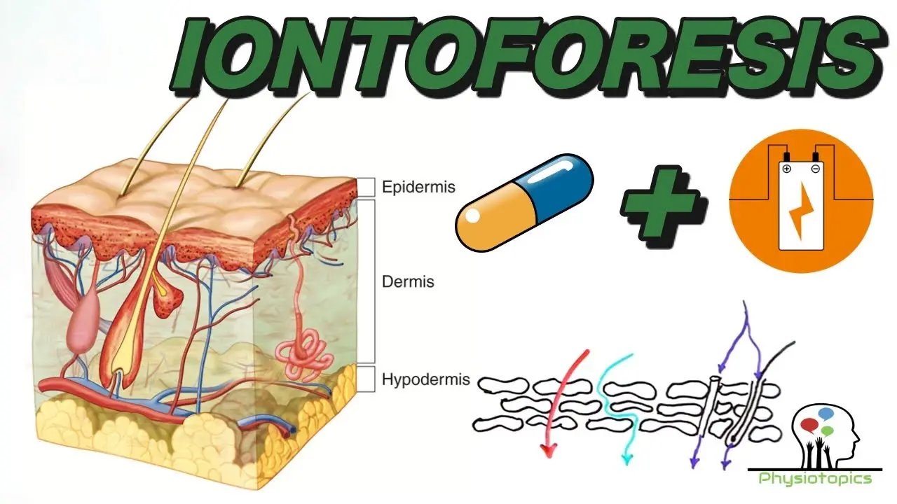 Iontoforesis en lesiones deportivas: ¿eficaz o sobrevalorada? - Qué es la iontoforesis y cómo funciona iontoforesis - Qué es la iontoforesis y cómo funciona