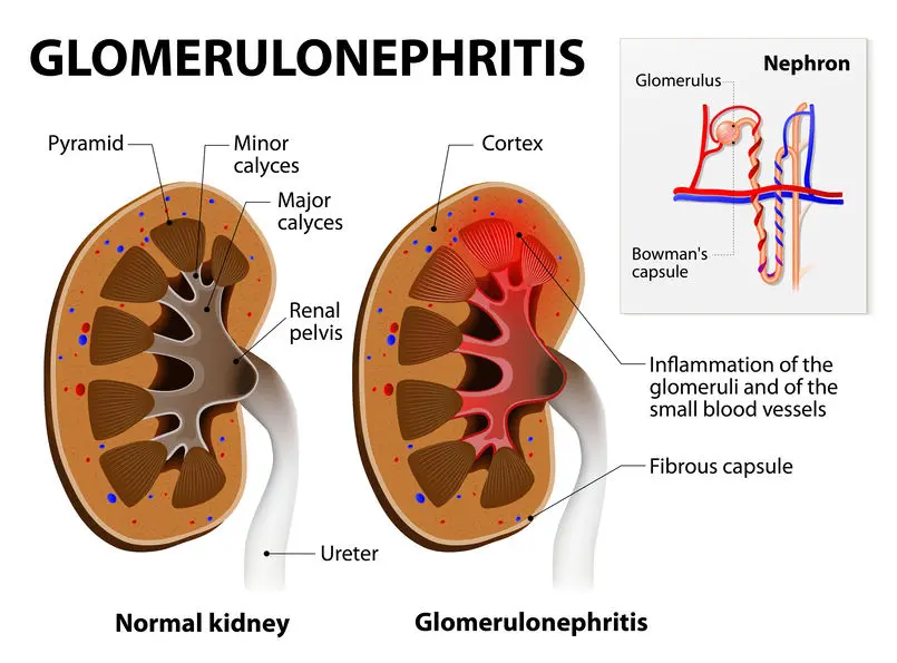 Glomerulonefritis: causas, síntomas, tratamiento y prevención - Qué es la lesión glomerular globulonefritis - Qué es la lesión glomerular