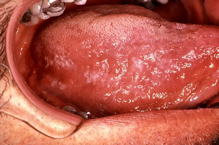 Leucoplasia Oral: Síntomas, Causas, Diagnóstico y Tratamiento - Qué es la leucoplasia uterina leucoplasia pilosa - Qué es la leucoplasia uterina