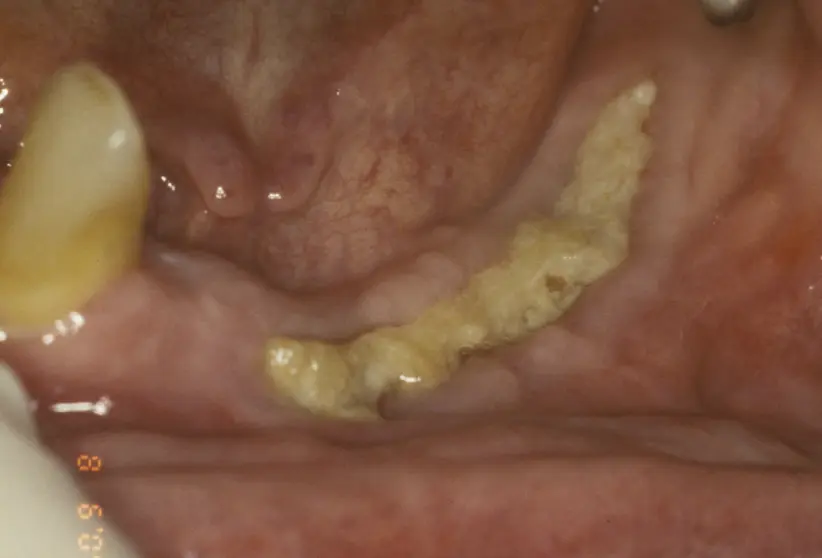 Osteonecrosis Mandibular: Causas, Síntomas y Tratamiento - Qué es la osteonecrosis maxilar y cuáles son sus causas y efectos en la cavidad bucal osteonecrosis mandibular - Qué es la osteonecrosis maxilar y cuáles son sus causas y efectos en la cavidad bucal
