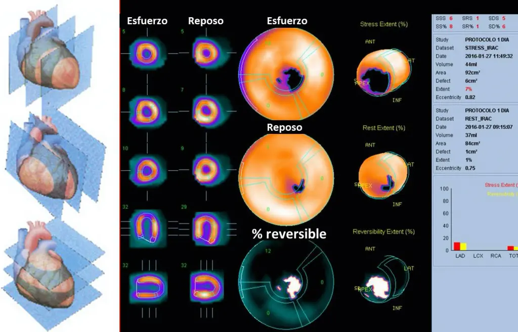 Perfusión miocárdica: Un examen para evaluar la salud del corazón - Qué es la perfusión miocárdica con estrés farmacológico perfusión miocárdica riesgos - Qué es la perfusión miocárdica con estrés farmacológico