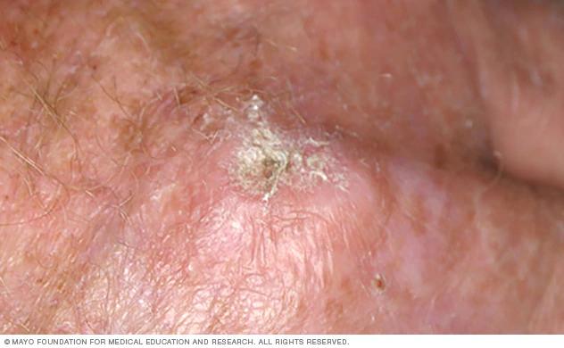 Queratosis Actínica Hipertrófica: Qué Es, Causas, Síntomas y Tratamiento - Qué es la queratosis actínica hipertrófica queratosis actinica hipertrofica - Qué es la queratosis actínica hipertrófica