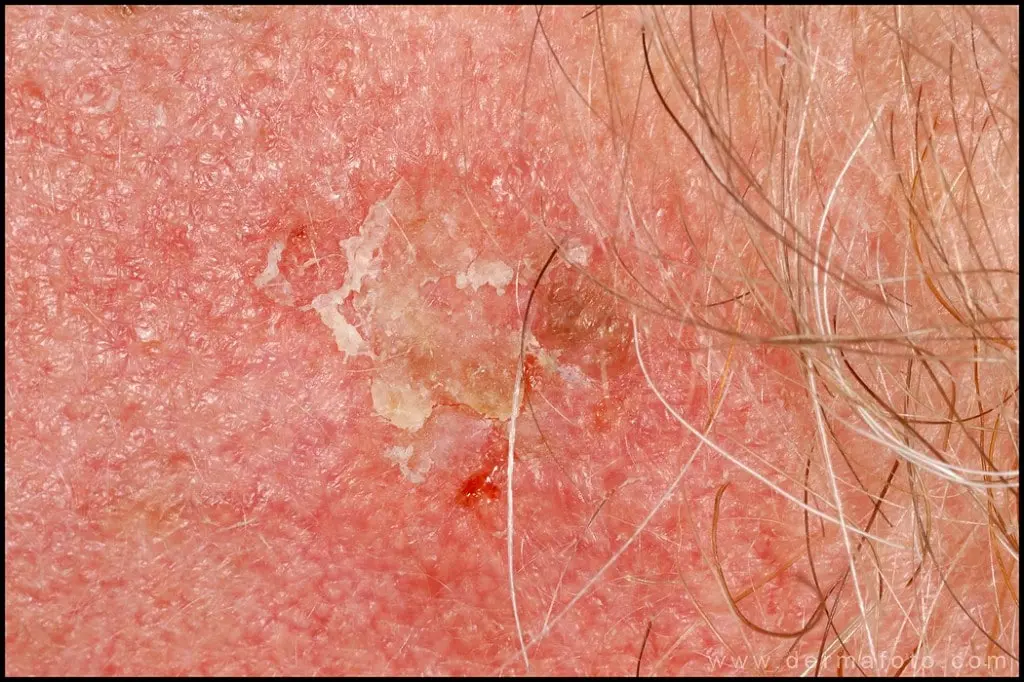 Queratosis Actínica Hipertrófica: Qué Es, Causas, Síntomas y Tratamiento - Qué es la queratosis actínica y el cáncer queratosis actinica hipertrofica - Qué es la queratosis actínica y el cáncer