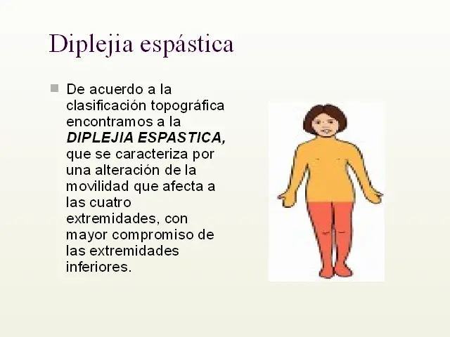 diparesia espastica - Qué es la triparesia