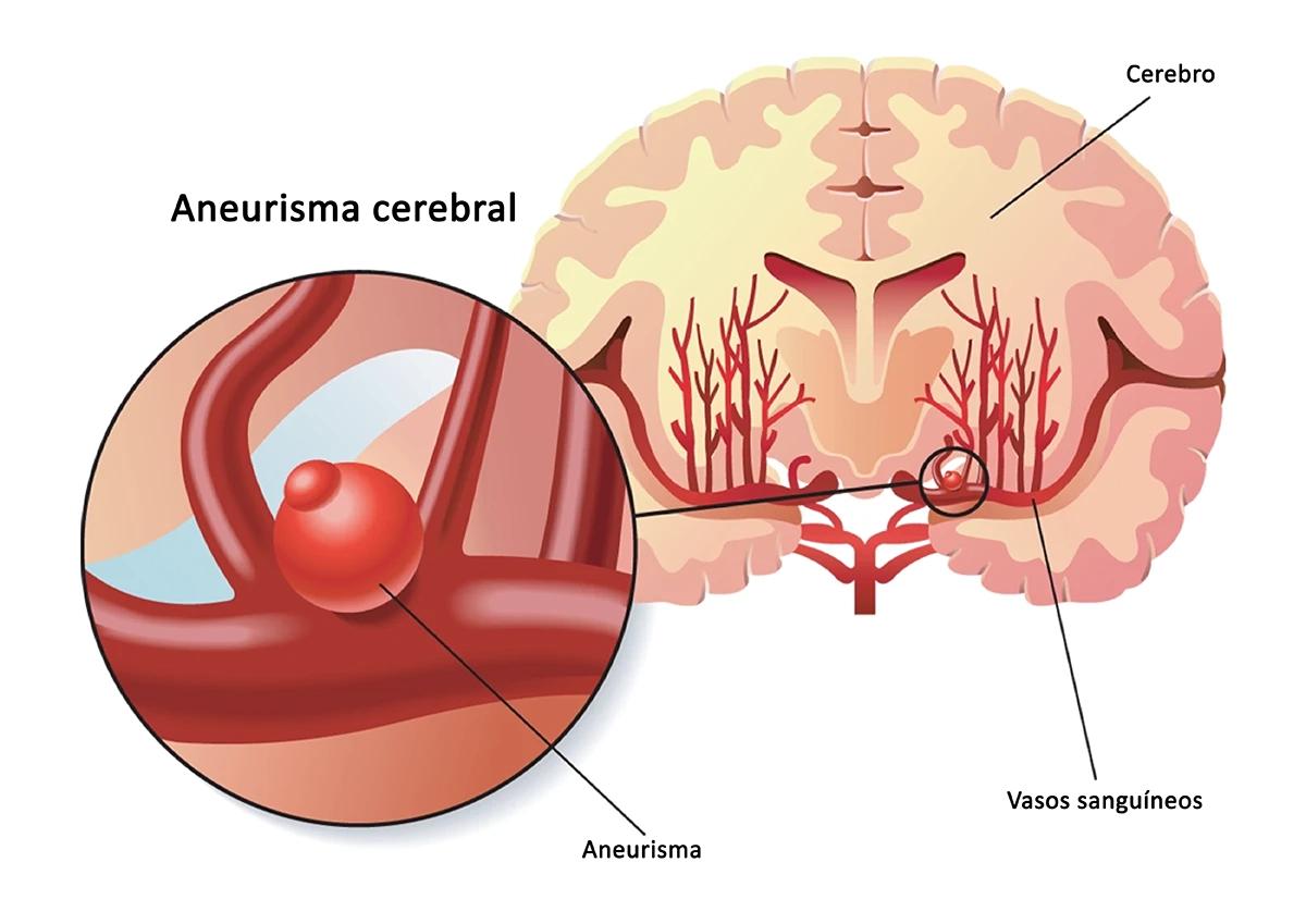 Aneurisma Cerebral: Causas, Síntomas, Diagnóstico y Tratamiento - Qué es lo que provoca el aneurisma cerebral que es aneurisma cerebral - Qué es lo que provoca el aneurisma cerebral