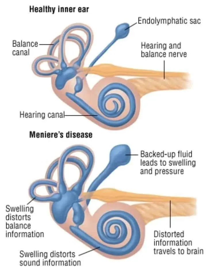 Síndrome de Ménière: Causas, Síntomas y Tratamiento - Qué es lo que provoca el síndrome de Ménière sindrome de meniere causas - Qué es lo que provoca el síndrome de Ménière