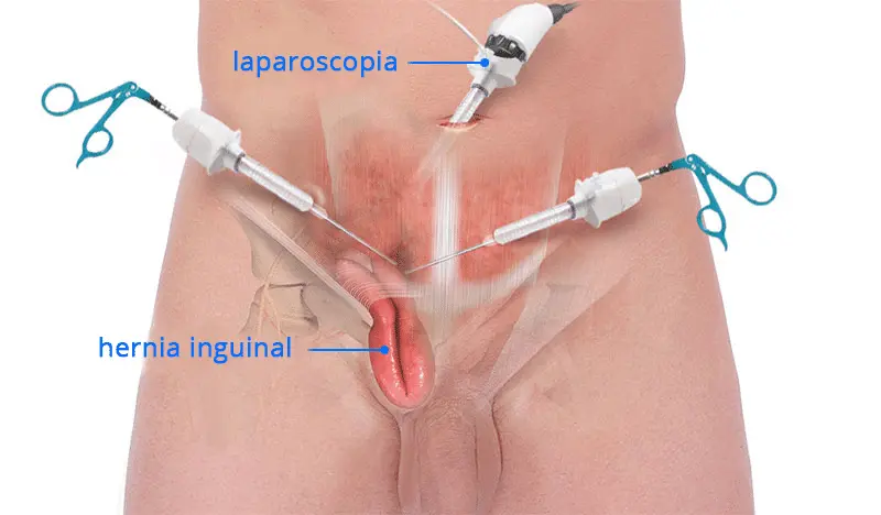 Hernioplastia Inguinal Laparoscópica vs. Cirugía Abierta: ¿Qué Opción es Mejor para Ti? - Qué es mejor, laparoscopia o cirugía abierta de hernia inguinal hernioplastia inguinal laparoscopica - Qué es mejor, laparoscopia o cirugía abierta de hernia inguinal
