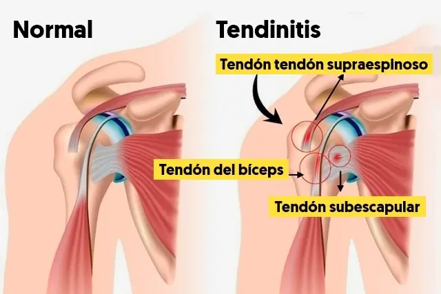 Tendinitis de hombro: remedios caseros y tratamiento - Qué es mejor para la tendinitis, el frío o el calor tendinitis de hombro remedios caseros - Qué es mejor para la tendinitis, el frío o el calor