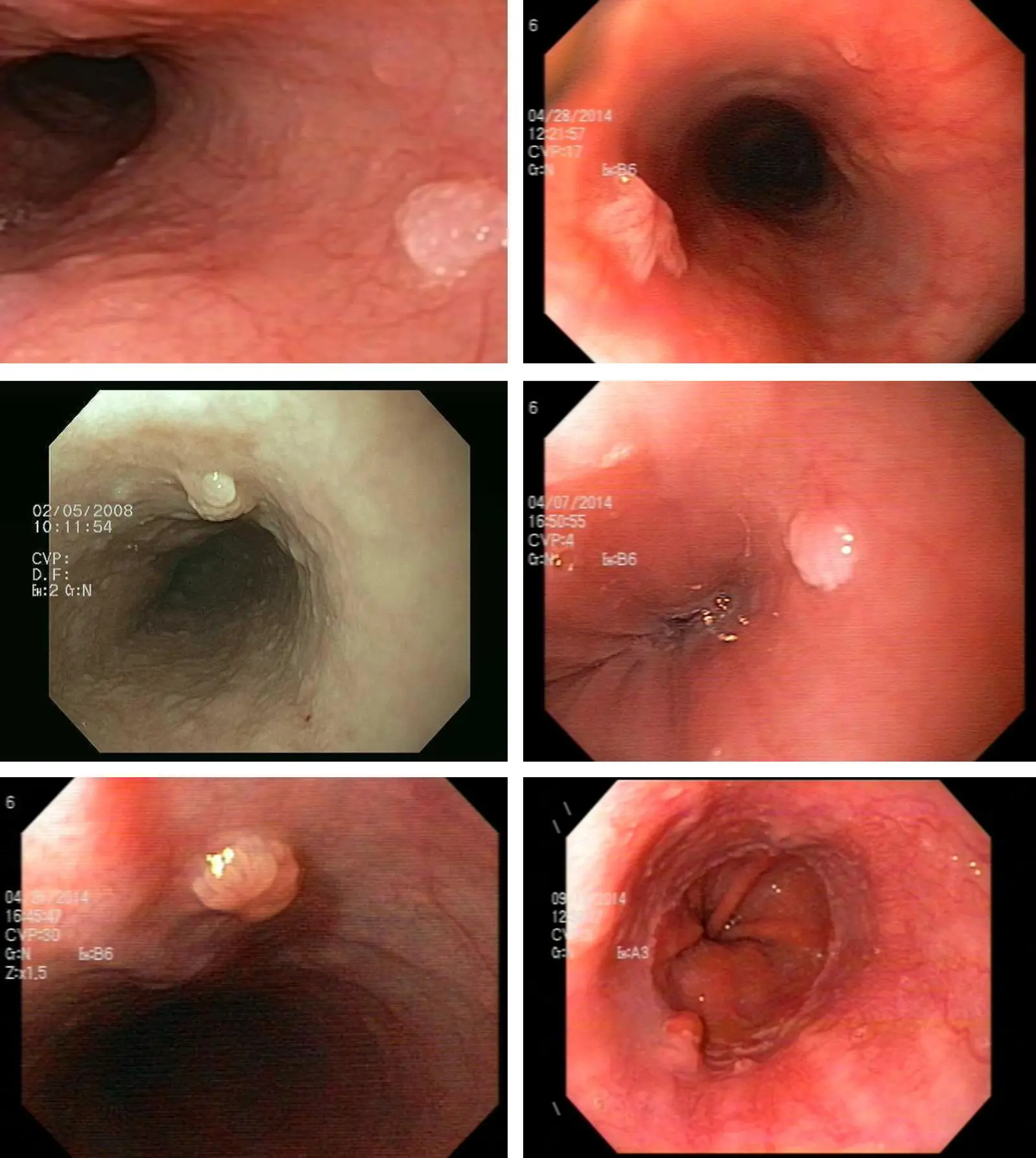 Papiloma escamoso del esófago: una revisión de casos - Qué es papiloma escamoso sin atipia acantopapilomatosis - Qué es papiloma escamoso sin atipia