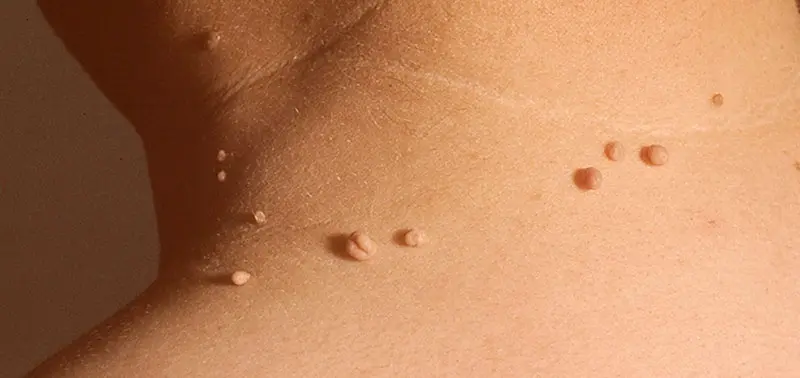 Papilomatosis Reticulada y Confluente: Un Enigma Cutáneo - Qué es papilomatosis en la piel papiloma cutaneo - Qué es papilomatosis en la piel
